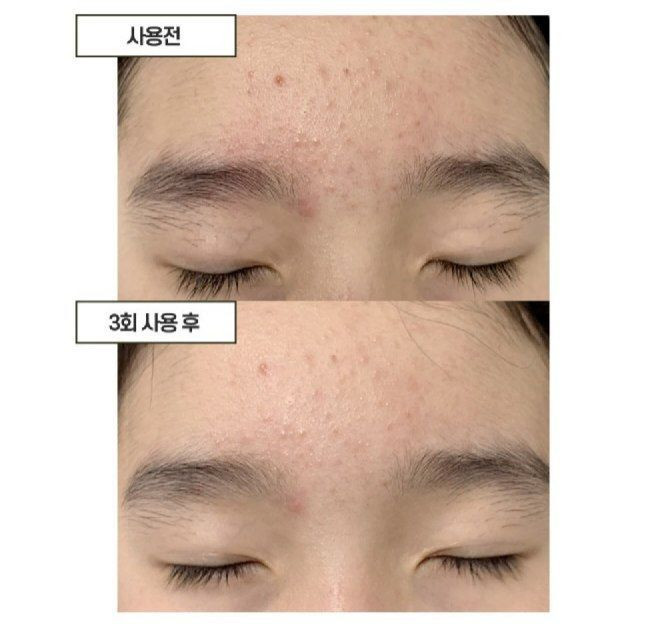کرم گوگرد ضدجوش و ضد قرمزی Musu🇰🇷